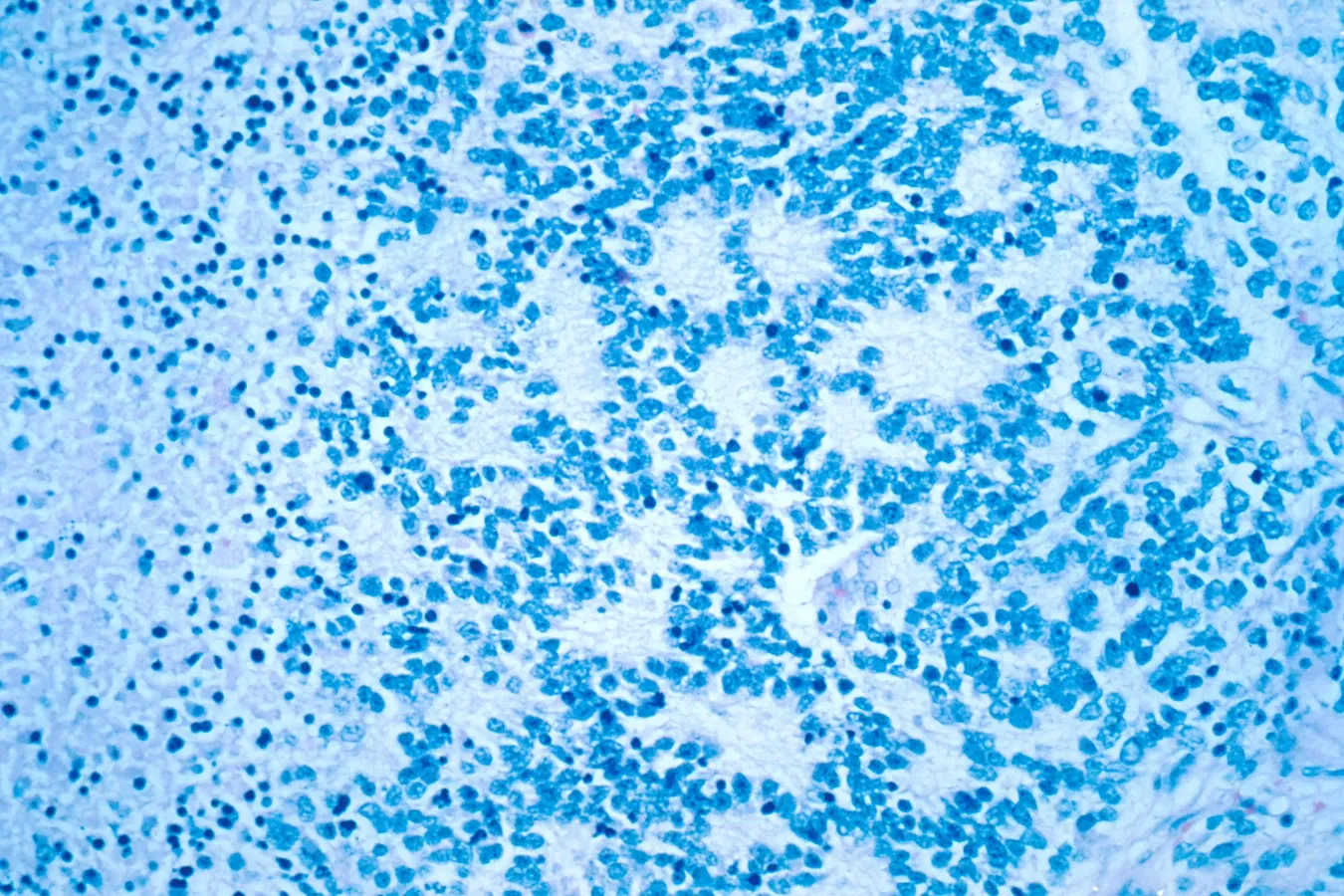 SERB Acquires Y-mAbs: Rare Oncology Expansion