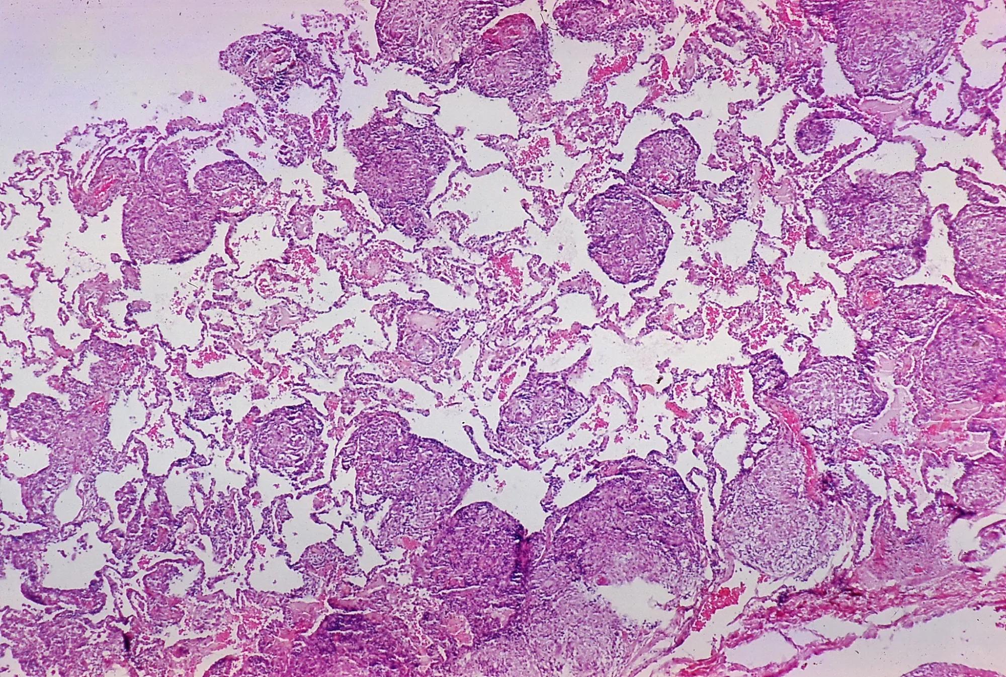 Sarcoidosis - Non-necrotizing granulomas diffusely distributed throughout the lung