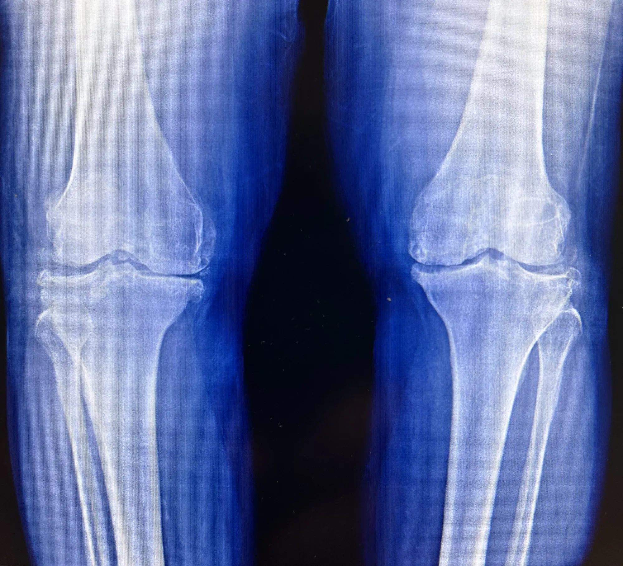 Knee Osteoarthritis (OA)