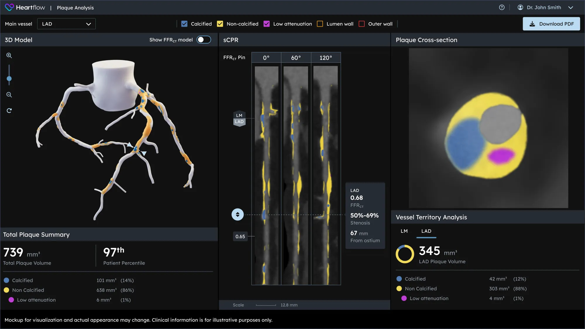 Next Generation Heartflow Plaque Analysis