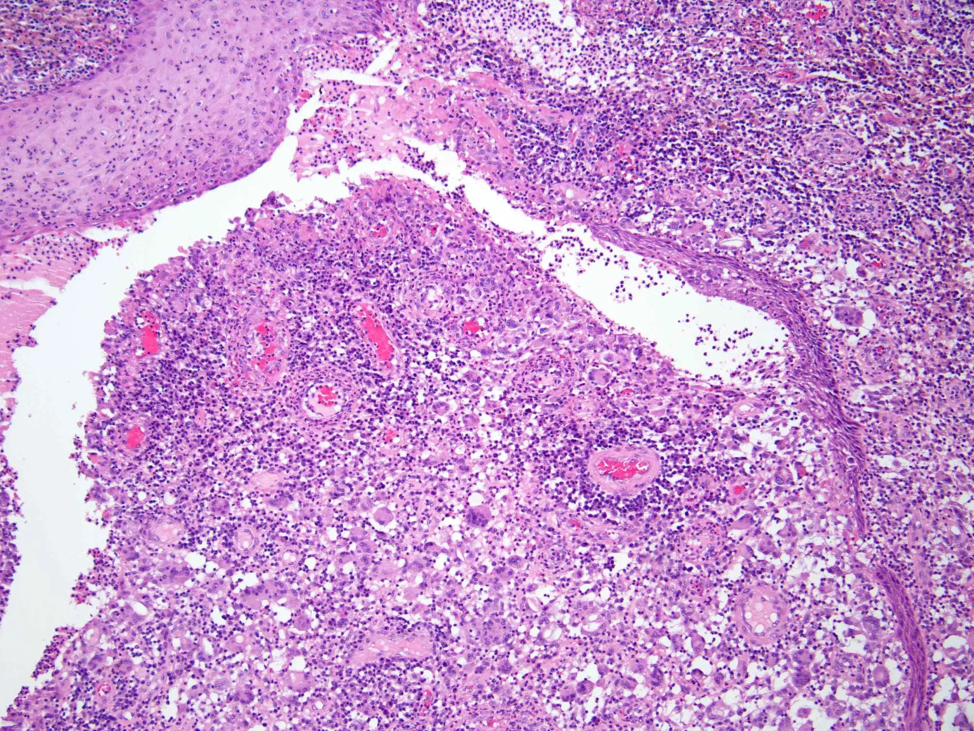 Hidradenitis Suppurativa