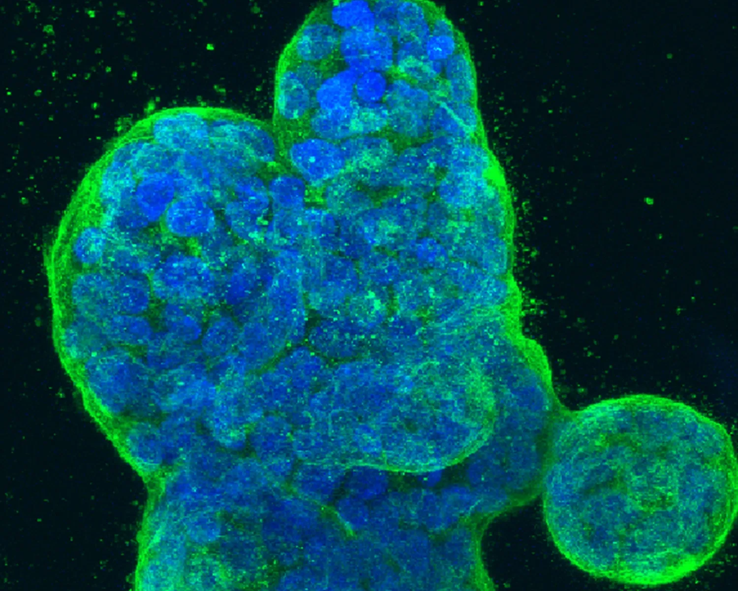 A three-dimensional culture of human breast cancer cells