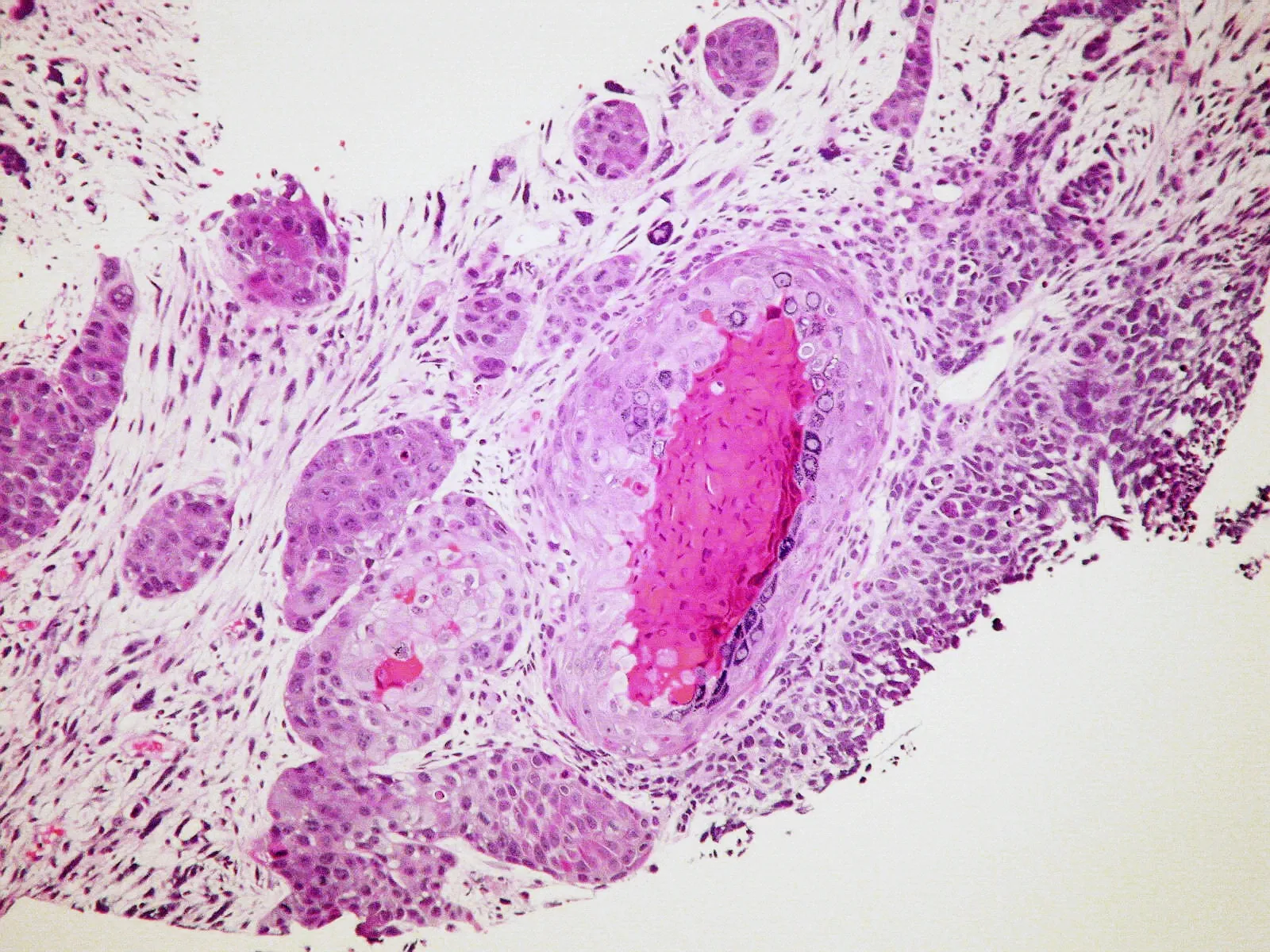 Squamous Cell Carcinoma (SCLC)