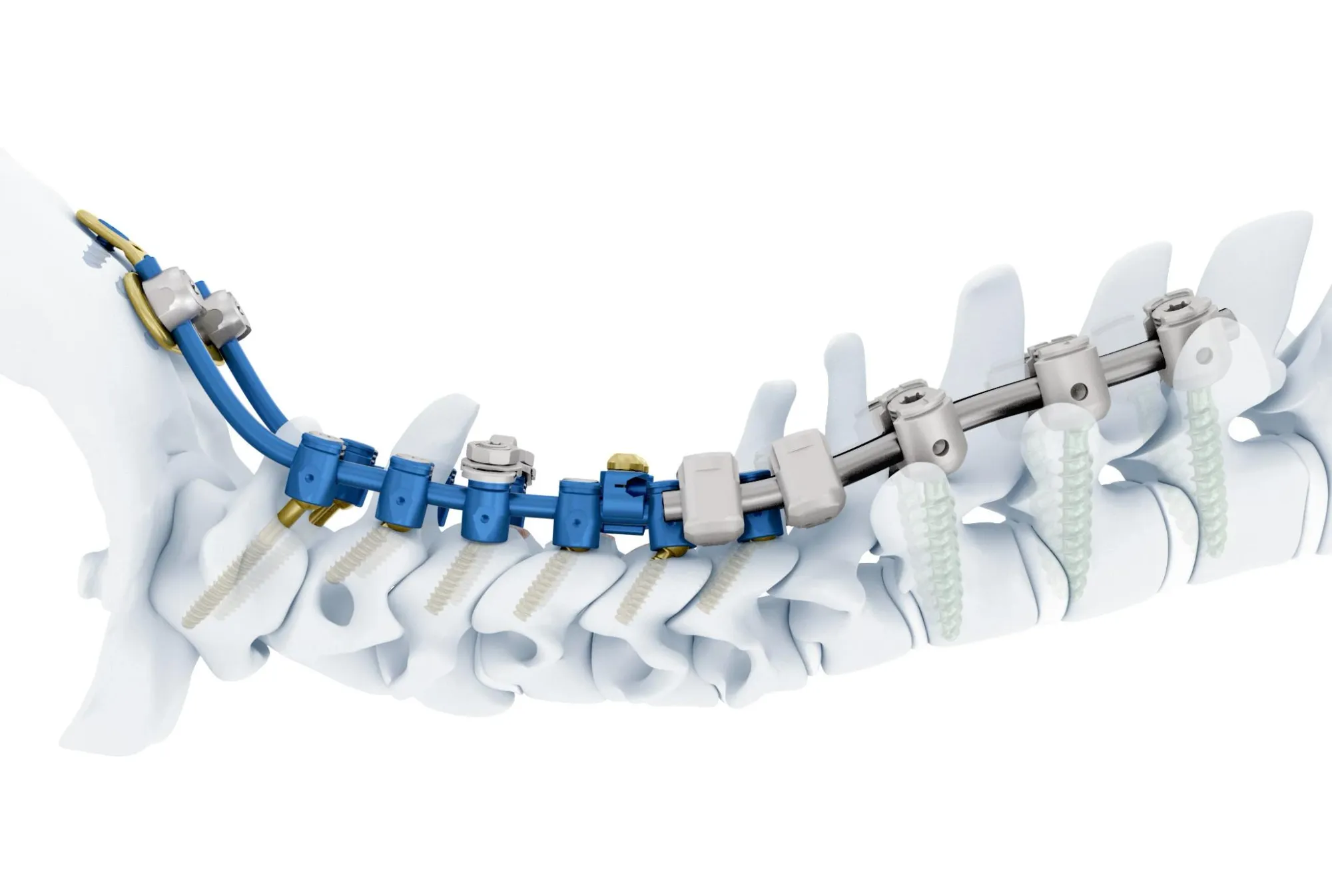 New System For Cervical Spine Disorders | DePuy Synthes