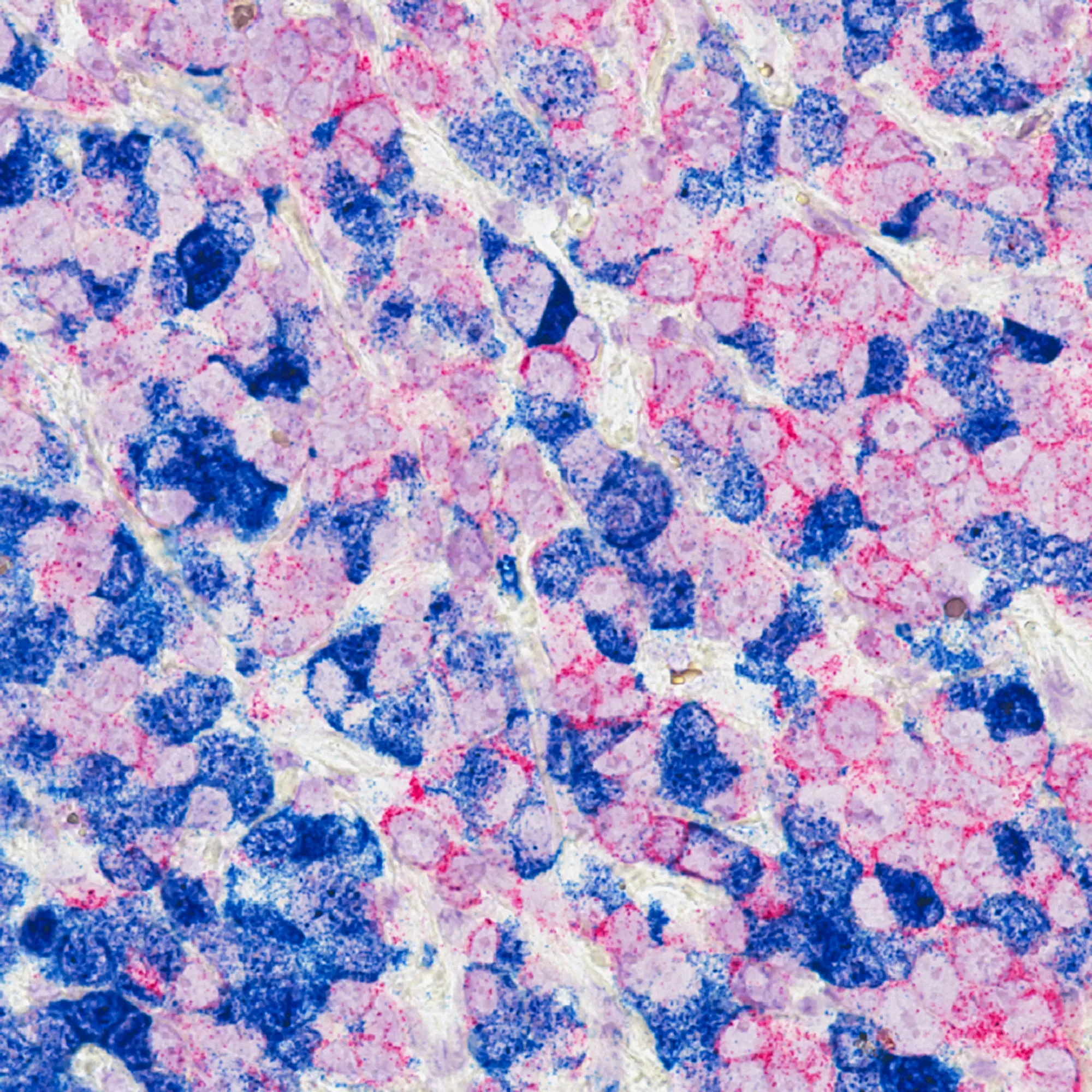 Breast Cancer Cells