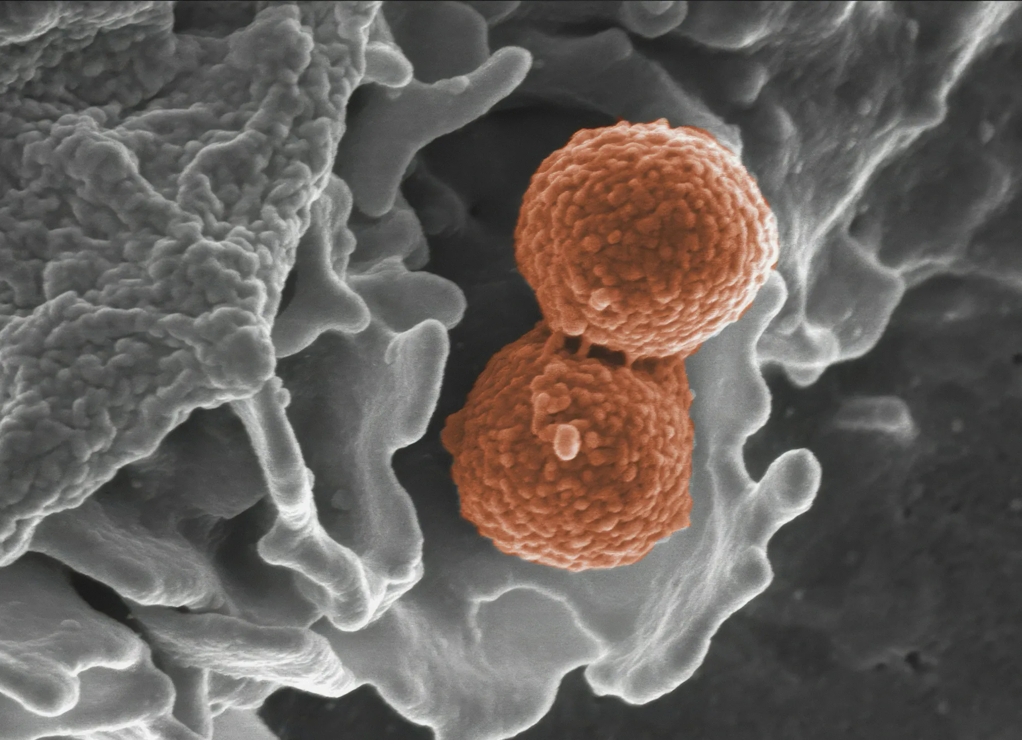 Methicillin-resistant Staphylococcus aureus (MRSA) 