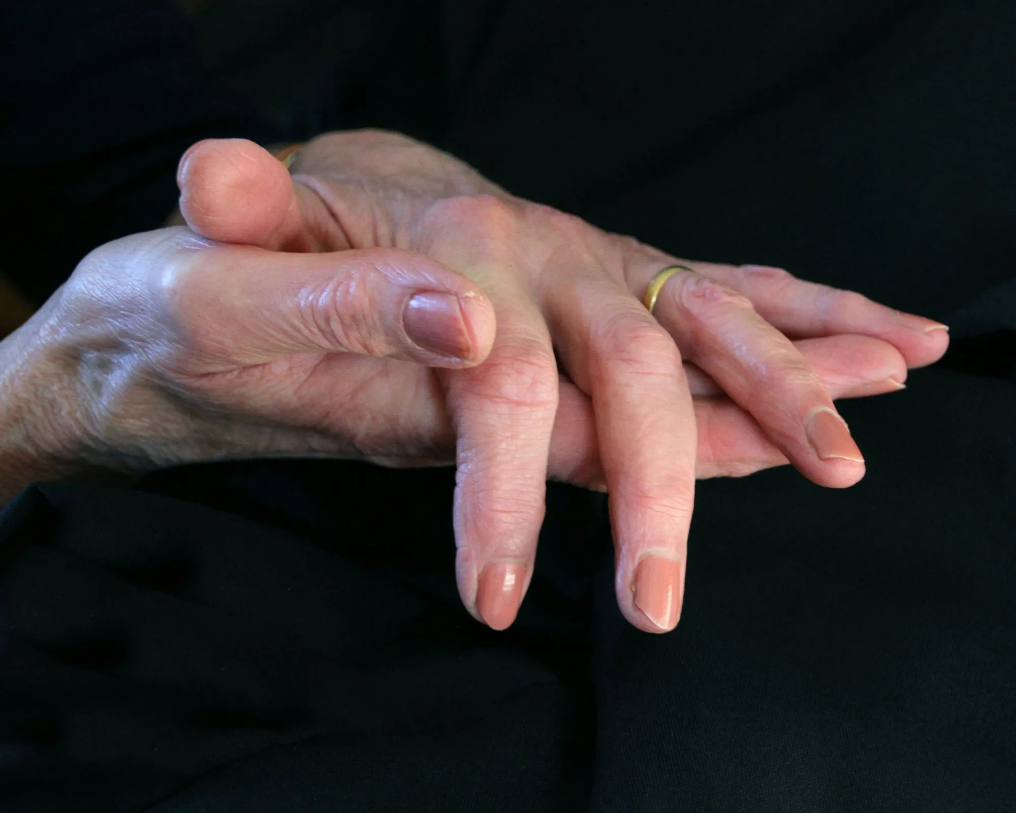RA treatment