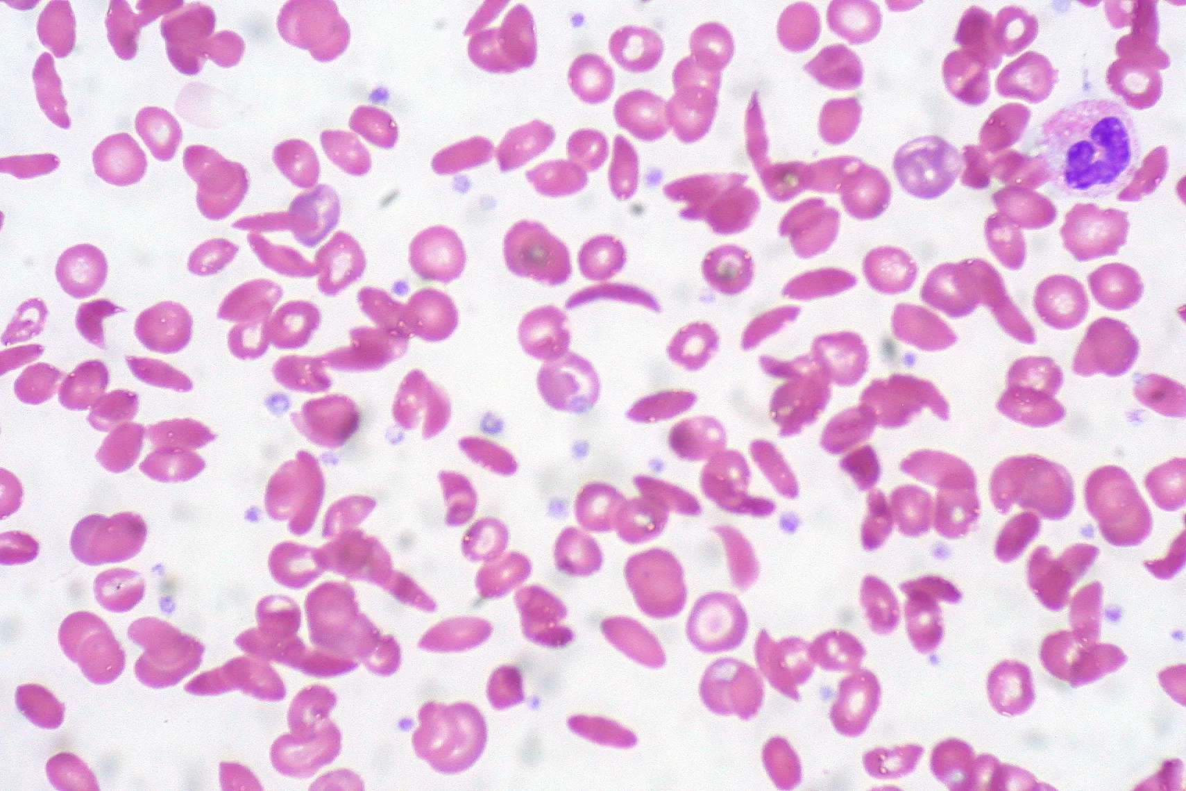 Higher Dose Sickle Cell Pill Shows Improved Results, But Experts Urge Caution
