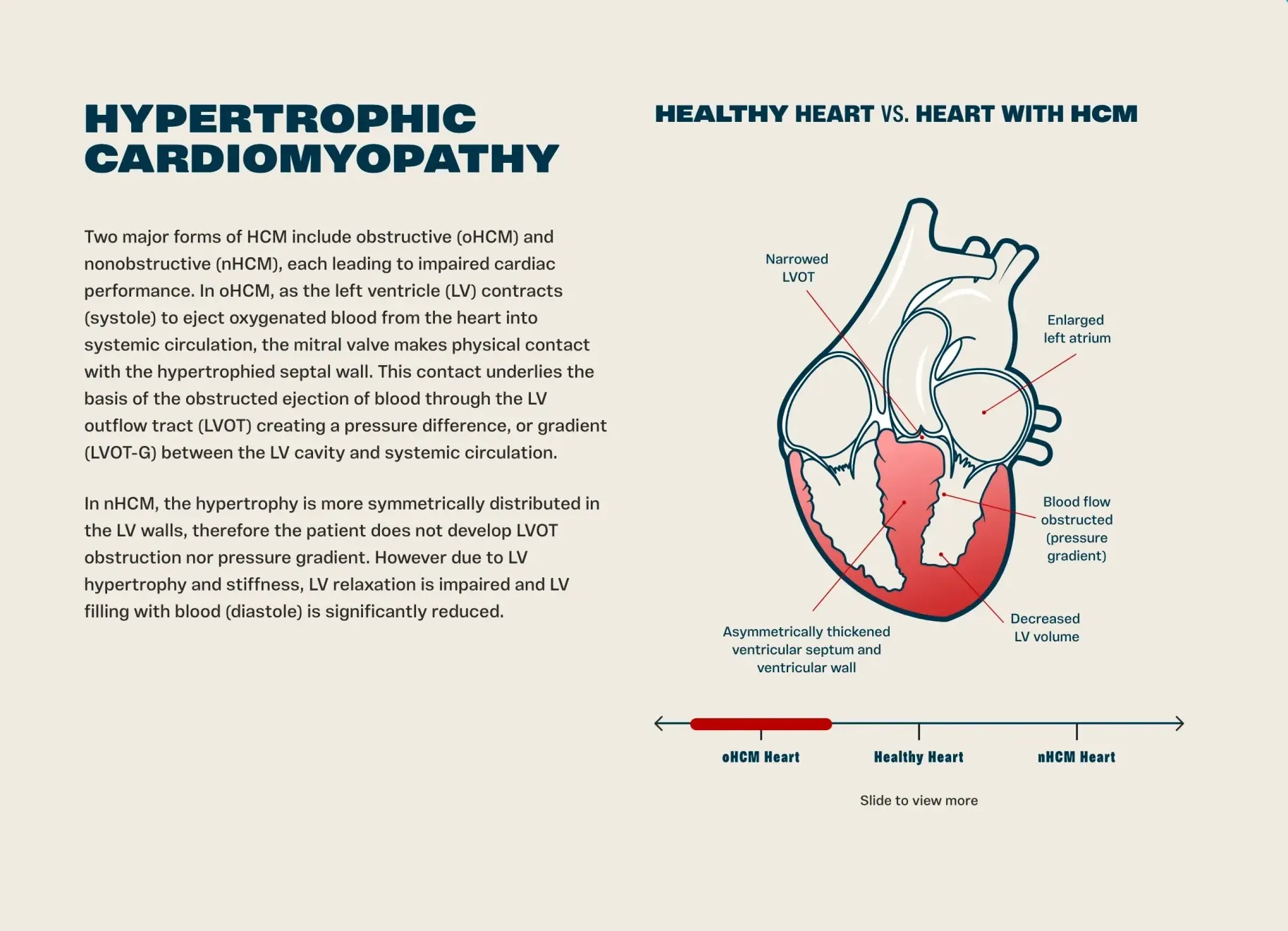 Edgewise EDG-7500 Shows Promising Heart Disease Trial Results