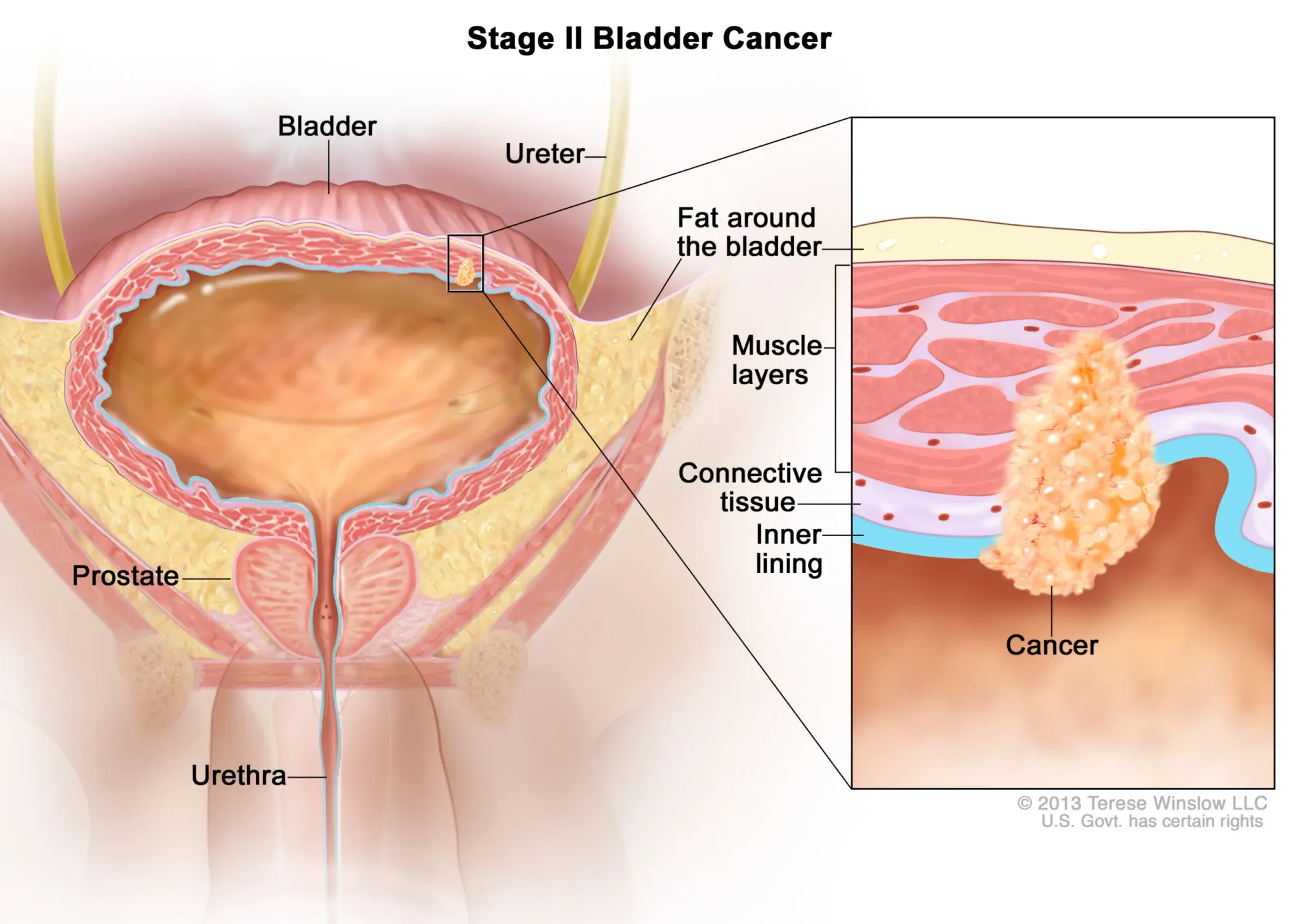 ImmunityBio Moves Forward with FDA on Bladder Cancer Treatment ANKTIVA
