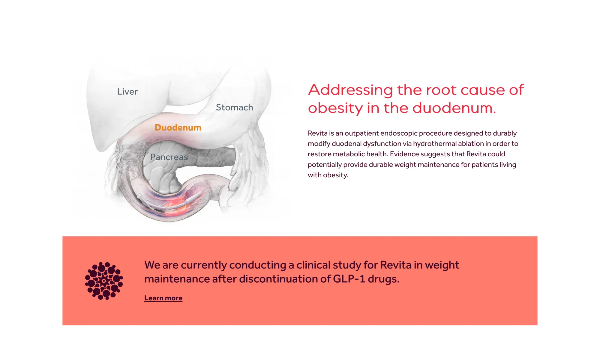 Fractyl's Weight Maintenance Study Shows Modest Results After GLP-1 Stoppage
