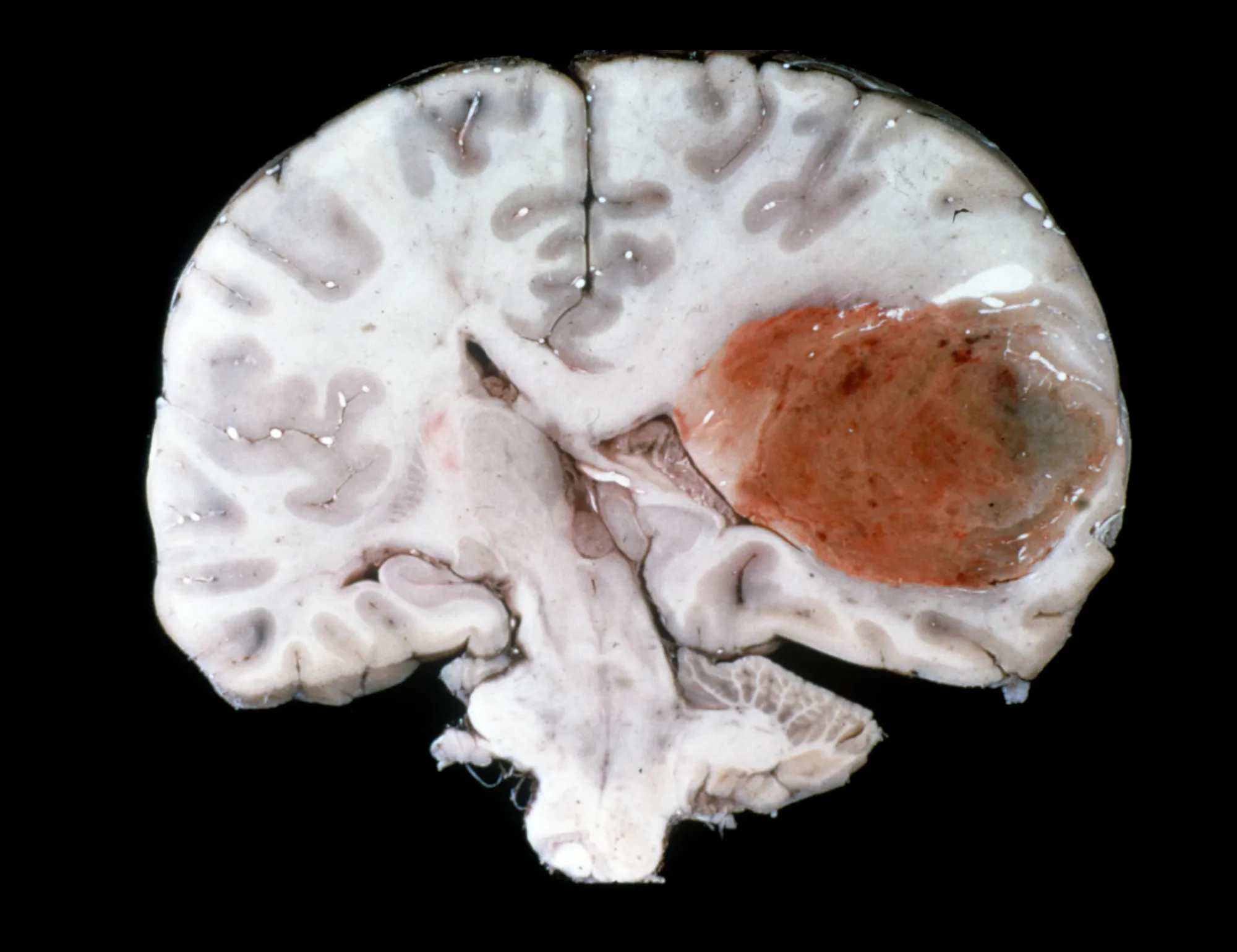 Alpha Tau Reports Breakthrough Interim Results in Brain Cancer Trial: 100% Disease Control and 67% Complete Response