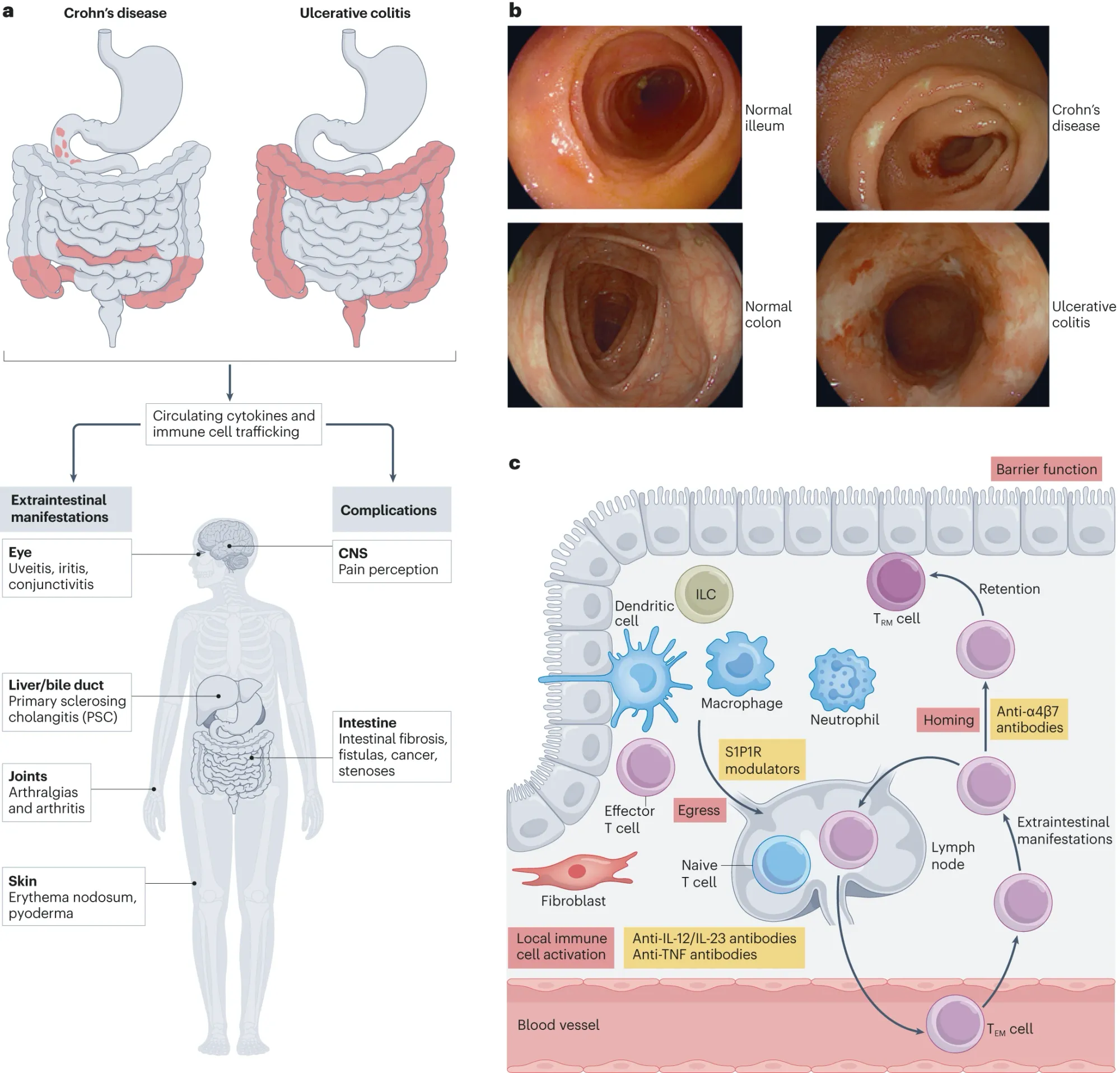 Adial Pharmaceuticals Acquires Azora and Raises Up to $64 Million for New Ulcerative Colitis Drug