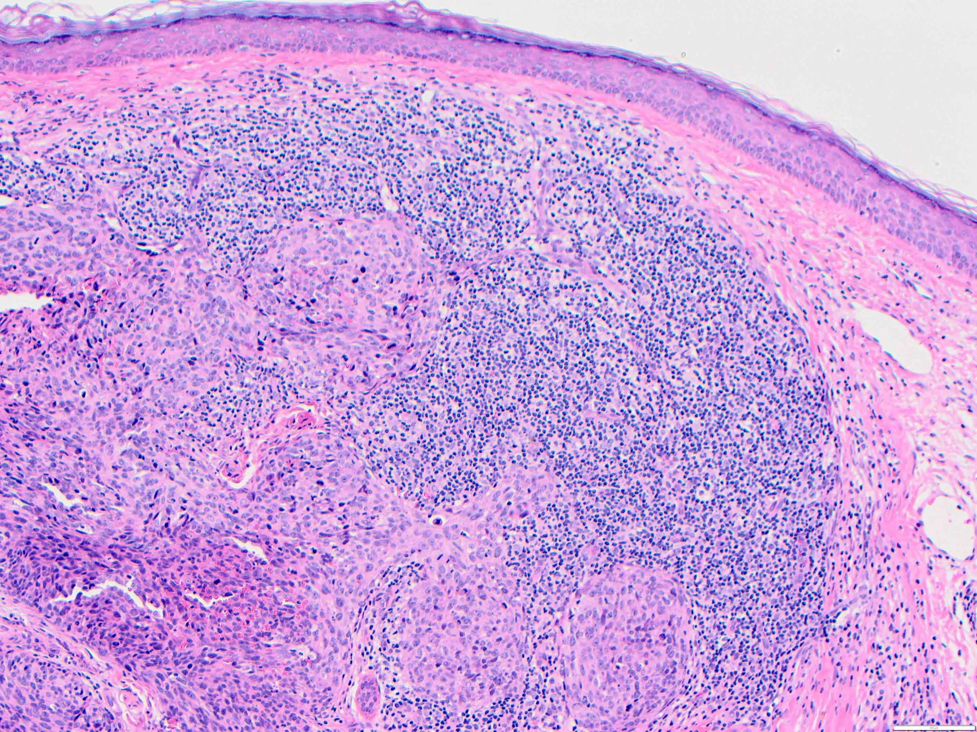 Tempus AI Shares Rise on New Angiosarcoma Research Collaboration
