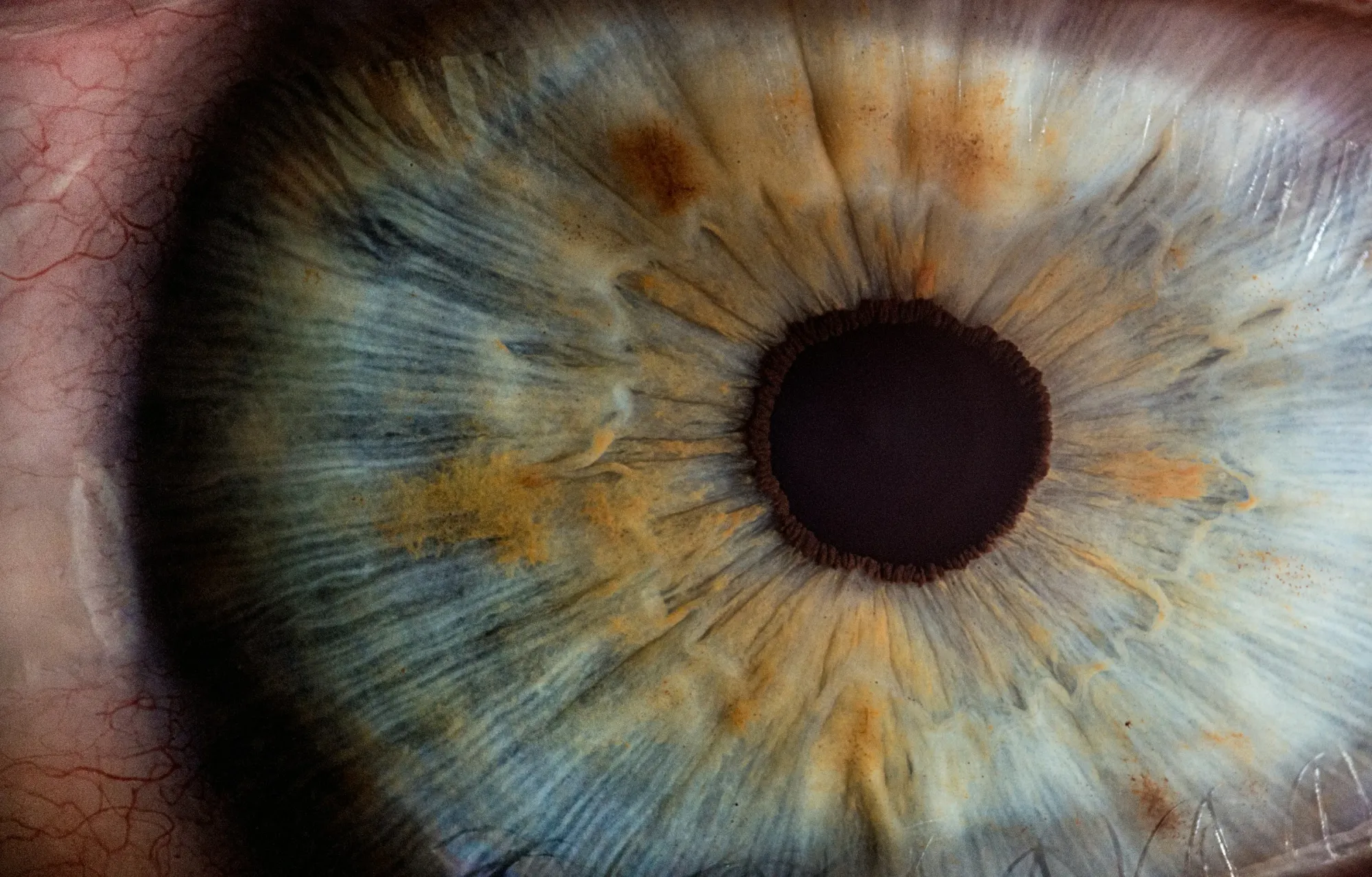 Outlook Therapeutics Resubmits FDA Application for LYTENAVA – Wet AMD Treatment One Step Closer to Approval