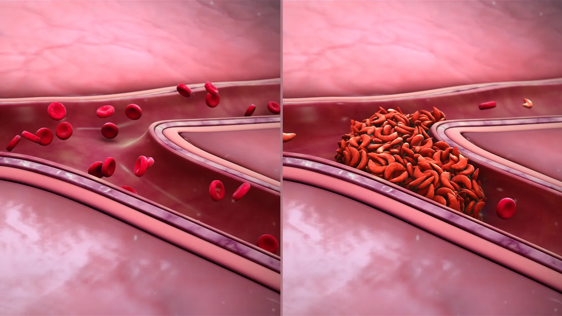 Agios Ends Tebapivat Program in Sickle Cell Disease, Focuses on Mitapivat