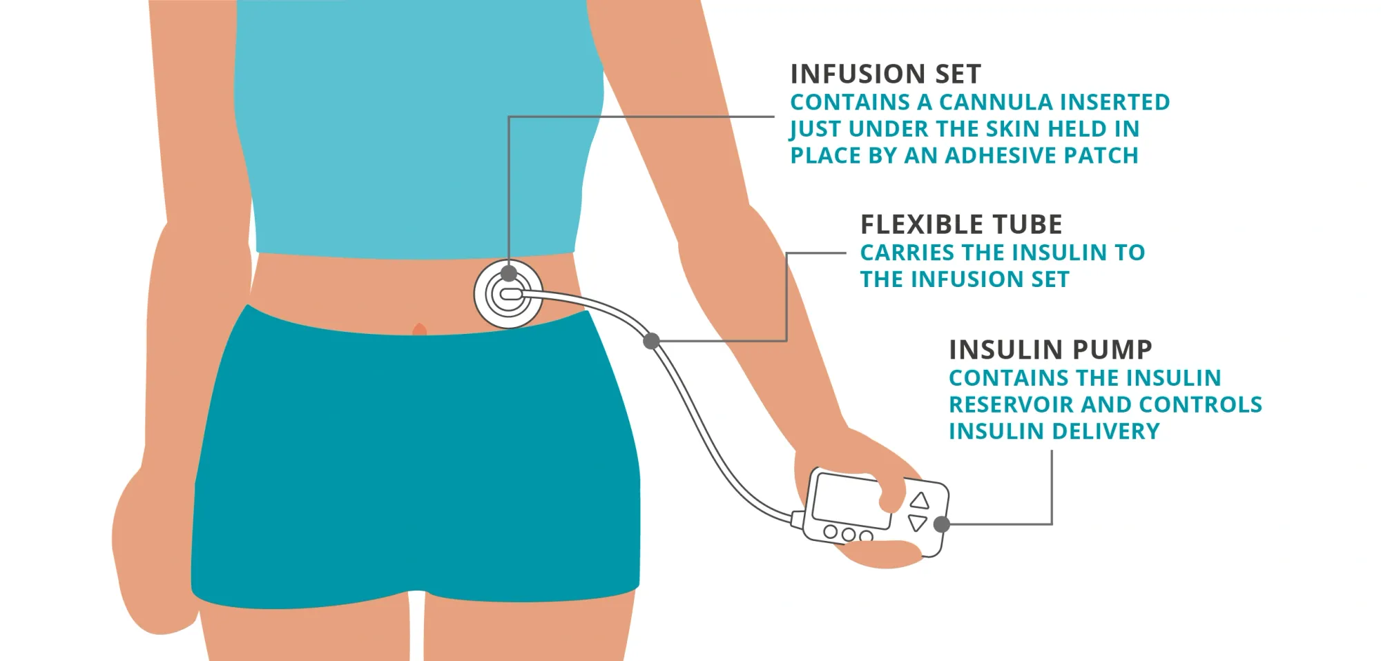 Insulet Shares Plunge After Cutting 2026 Sales Forecast on Slower U.S. Omnipod Growth