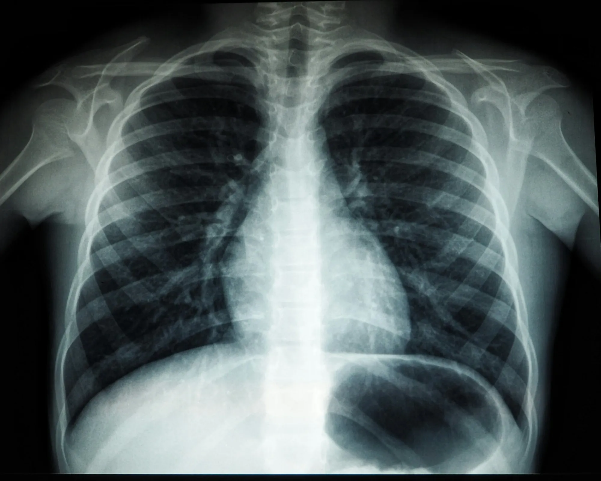 Ivonescimab Cuts Death Risk 27% vs Keytruda, With Strongest Gain in High PD-L1 Patients
