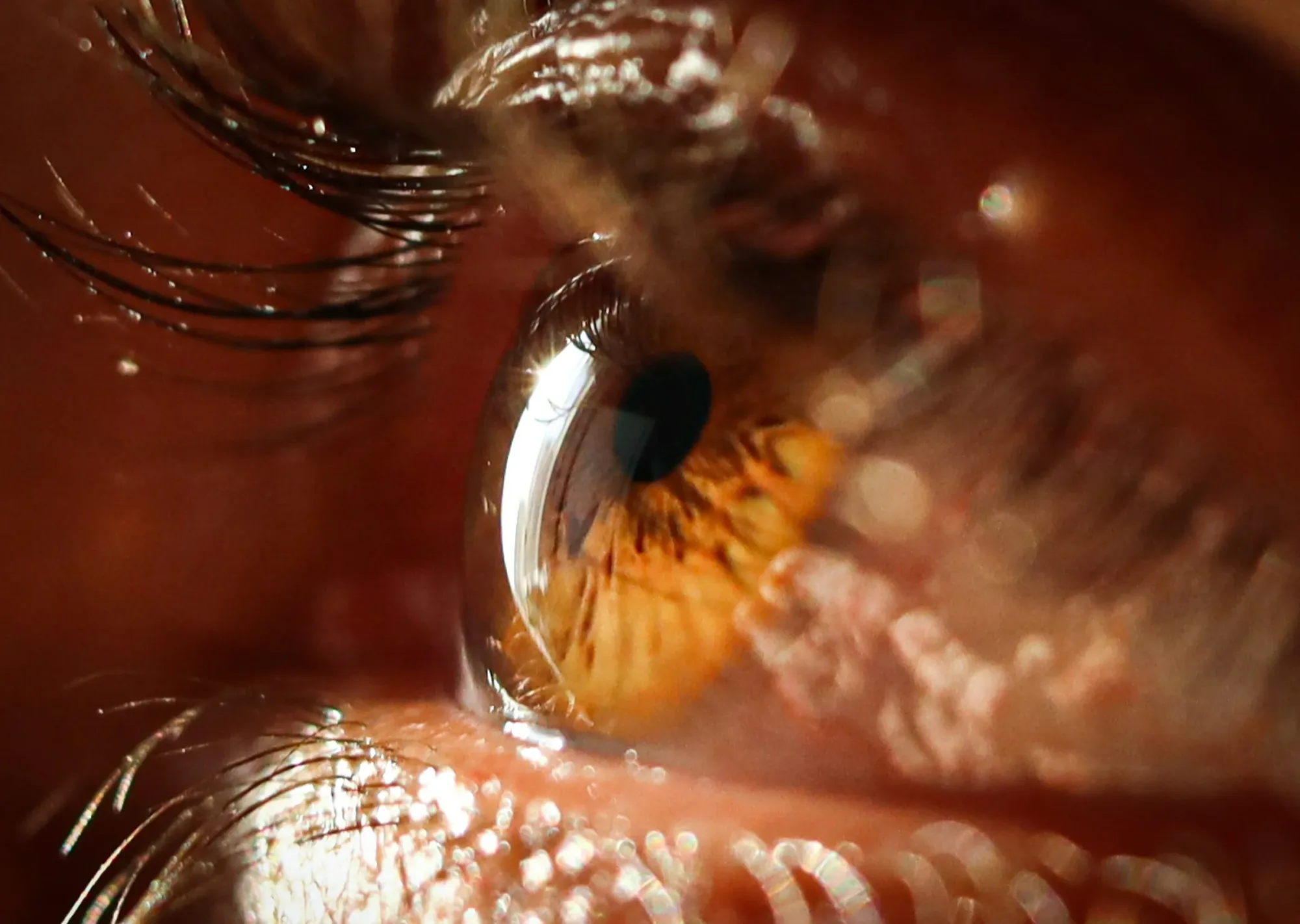 4DMT’s 4D-150 Moves Into Phase 3 for DME, Intensifying Pressure on Ocular’s AXPAXLI