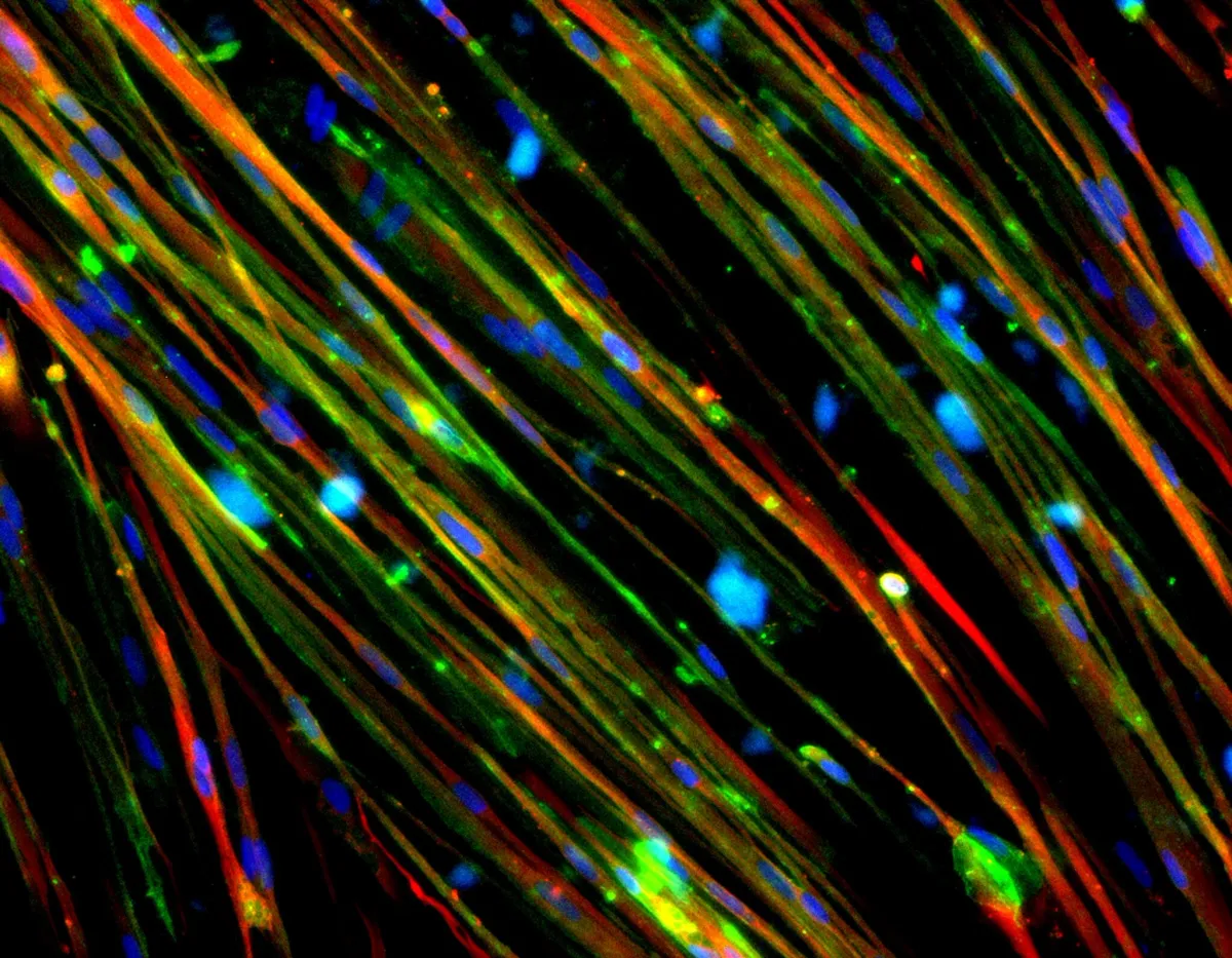 Capricor's HOPE-3 Trial: Clear Path Ahead for DMD Treatment