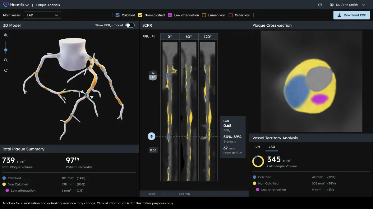 HeartFlow Gets FDA Approval for Next-Gen Heart Plaque Detection Technology; Cigna Coverage 2025