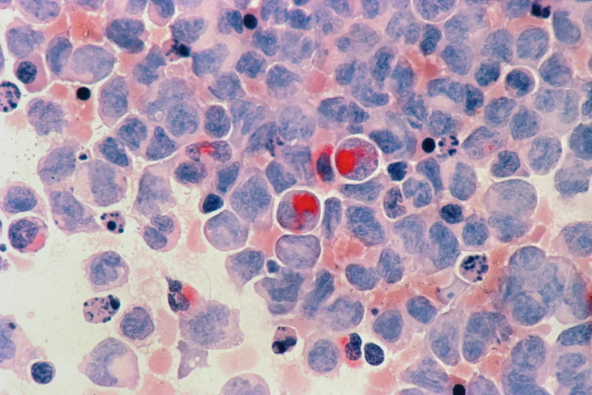 FDA Approves Revuforj for Relapsed NPM1 Mutated Acute Myeloid Leukemia