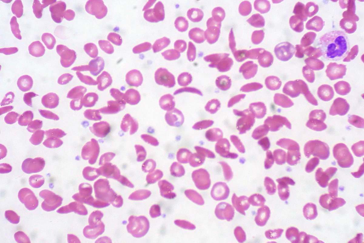 Higher Dose Sickle Cell Pill Shows Improved Results, But Experts Urge Caution