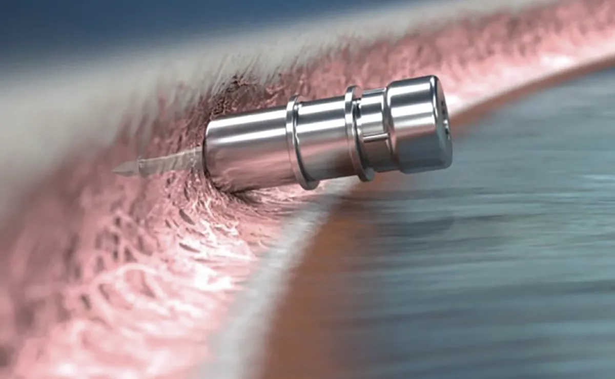 FDA Approves Repeat Treatment for iDose TR Glaucoma Implant