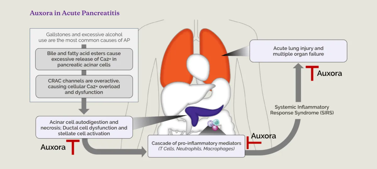 FDA Alignment De-Risks CalciMedica’s Auxora Path in Acute Pancreatitis
