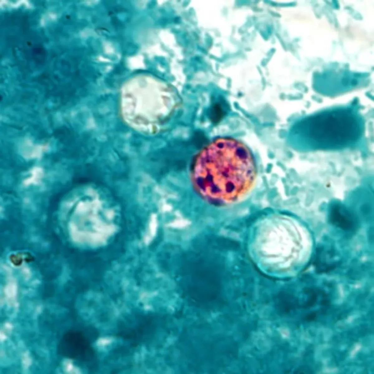 Cyclospora Outbreak Reaches Record Size as Michigan Reports First US Deaths